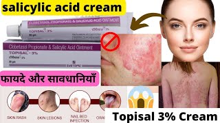 Clobetasol propionate and salicylic acid ointmentTopisal 3 cream Salicylic acid creamAcne [upl. by Prochoras888]