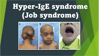 Hyper IgE syndrome Job Syndrome  Immunology USMLE Step 1 [upl. by Nirda]