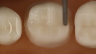 PFM Crown Posterior Tooth Preparation With Metal Occlusal [upl. by Halette]