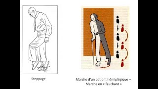 Fauchage et Steppage  Neurologie [upl. by Urbano357]