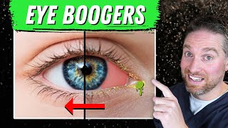 How To Get Rid Of Eye Boogers And Crust 3 Causes and Treatments [upl. by Alper960]