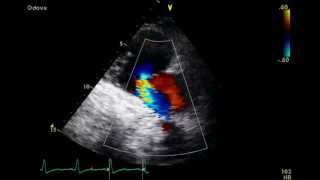 Pulmonary Embolism  Mcconnells Sign  Transthoracic Echocardiogram TTE [upl. by Jarlathus]