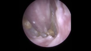 Infected Debris and Discharge Suctioned off Ear Canal and Eardrum  353 [upl. by Ssitruc]