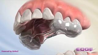 Rapid Palatal Expander RPE [upl. by Beatrice397]