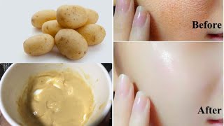 Potato Face Pack For Glowing Skin Pigmentation Acne Scars Clear Skin Beesan face pack [upl. by Kristie818]