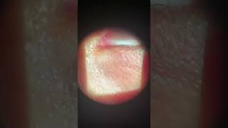 Tear duct  punctal plug insertion [upl. by Adliwa]