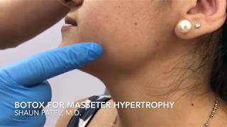 Botox treatment of the masseter muscle by Dr Shaun Patel in Miami Florida [upl. by Namqul521]