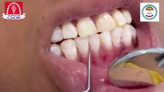 DEANS FLUOROSIS INDEX [upl. by Eentrok]