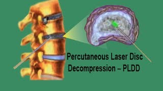 PLDD  Percutaneous Laser Disc Decompression [upl. by Ahsiniuq257]