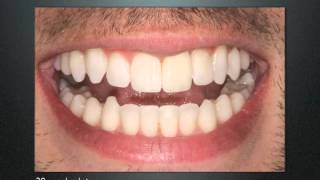 Inman Aligner Video [upl. by Pickens]