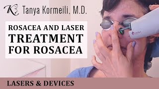 Rosacea and laser treatment for rosacea [upl. by Petulah]