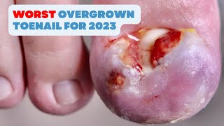 THE BESTWORST OVERGROWN TOENAIL FOR 2023 [upl. by Arocahs]