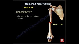 Humerus Fractures  Everything You Need To Know  Dr Nabil Ebraheim [upl. by Arbrab]