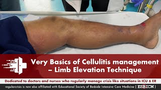 Very Basics of Cellulitis Management Limb Elevation Technique  Dr Manish Khasgiwale  ESBICM [upl. by Ahseniuq]