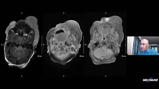 Pediatric Neuroradiology CLOVES Syndrome [upl. by Evatsug]