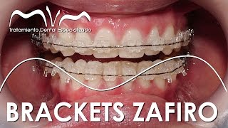 TODO SOBRE LOS BRACKETS ZAFIRO  ¿YA TE DECIDISTE [upl. by Cerveny]