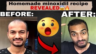 Homemade minoxidil making recipe finally revealed😱🔥 [upl. by Yvaht326]