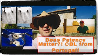 Retreatment Success Without Apical Patency CBL Vlog from Algarve Portugal [upl. by Gus316]