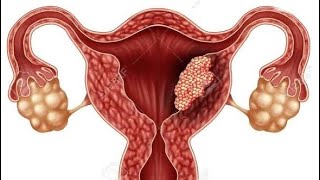 MOLAR PREGNANCY  MADE EASY EXPLANATION [upl. by Sorcha]