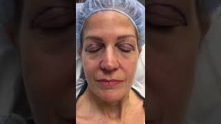 Watch This Droopy Eyelid Transformation upperbleph upperblepharoplasty eyelidsurgery eye [upl. by Narah985]