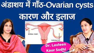 Ovarian Cysts। ओवरी में सिस्ट क्यों हो जाती हैं क्या है इलाज। Dr Lavleen Sodhi [upl. by Retsev]