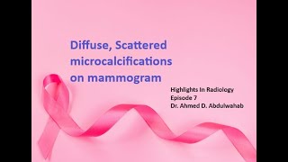 Diffuse Scattered microcalcifications on mammogram [upl. by Eceerehs]