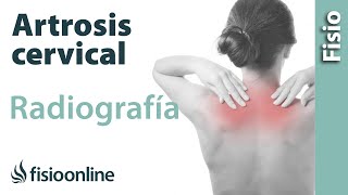 Artrosis cervical  Qué es y cómo se diagnostica en radiografías [upl. by Annyl]