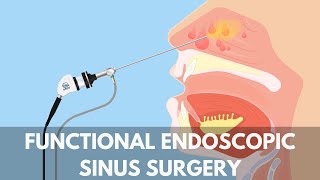 What is a Functional Endoscopic Sinus Surgery [upl. by Clercq238]