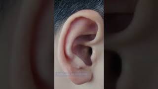 Tinnitus EXPOSED  Surprising Causes of Ringing in Ears 8 Menieres amp Labyrinthitis [upl. by Susi]