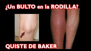 ¿Qué es ese bulto detrás de mi RODILLA El Quiste de BAKER [upl. by Enomor]