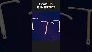 How Intrauterine Device IUD Is Inserted 3danimation medical medicalanimations [upl. by Hairahcez]