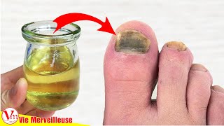 Comment Enlever Les Mycoses Des Ongles Des Pieds Rapidement Et Naturellement  Remèdes Maison [upl. by Somerset664]