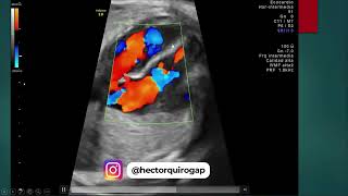 Ecocardiografía fetal Tips para evaluar el tabique interventricular [upl. by Firestone]