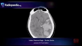 Stroke Lobar haemorrhage  radiology video tutorial MRI CT [upl. by Yxor711]