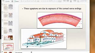 Bacterial Keratitis Part 1 [upl. by Nesilla]