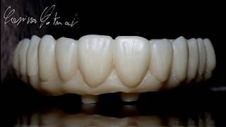 Zirconia Monolithic Implant Bridge [upl. by Luapnaes23]