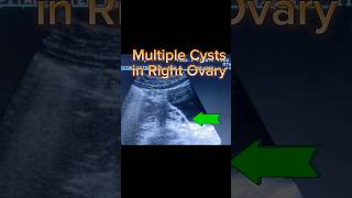 Polycystic Ovary ultrasound shorts [upl. by Falito]