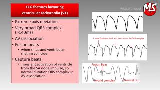 VT Ventricular Tachycardia vs SVT Supraventricular tachycardia with aberrancy [upl. by Marjorie216]