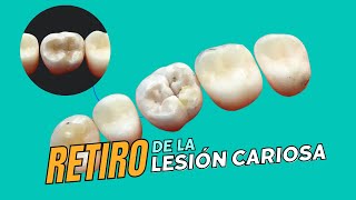 CURACIÓN de muela con resina con detalles  Oralay Dental [upl. by Nolur]