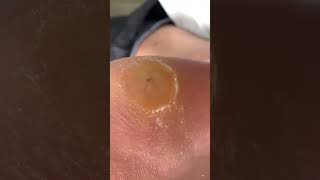 Foot scraping dead skin [upl. by Otanod]