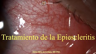 Tratamiento de la Epiescleritis [upl. by Brandtr]