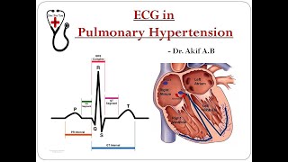 ECG changes in Pulmonary Hypertension  Dr Akif Baig [upl. by Jemima]