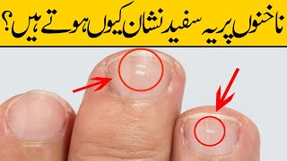 What Causes White Spots on Nails  UrduHindi [upl. by Fauver]