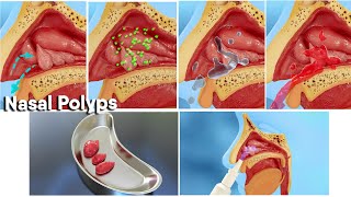 Nasal polyps treatment and surgery 3d medical animationDandelion Team nasalpolyp noose [upl. by Haeluj]