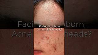 Single Serum to fight acne blackheads amp whiteheads😍 [upl. by Wobniar]