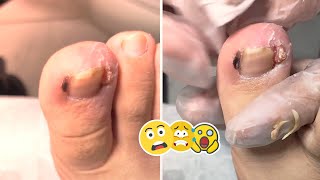 Ingrown toenail removal treatment [upl. by Asle299]