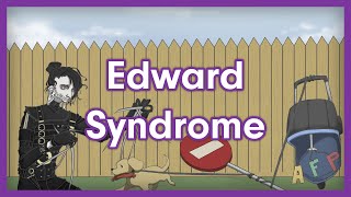 Edward Syndrome Trisomy 18  USMLE Step 1 Mnemonic [upl. by Aihsemot158]