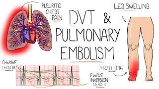 Deep Vein Thrombosis DVT amp Pulmonary Embolism Explained [upl. by Nochur495]