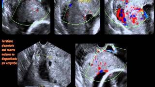 PLACENTA CASO DE ACRETISMO PLACENTARIO Y SHOCK HEMORRÁGICO [upl. by Phare]