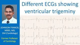 Different ECGs showing ventricular trigeminy [upl. by Gine]